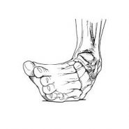 What To Do If You Sprain Your Ankle While Hiking