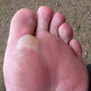 How to Prevent and Treat Hiking Blisters