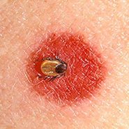 How To Avoid Ticks While Hiking Without Wearing Like 10 Layers Of Clothing